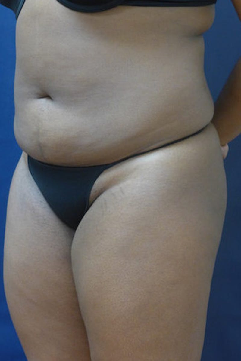 Liposuction Before & After Gallery - Patient 289959 - Image 1