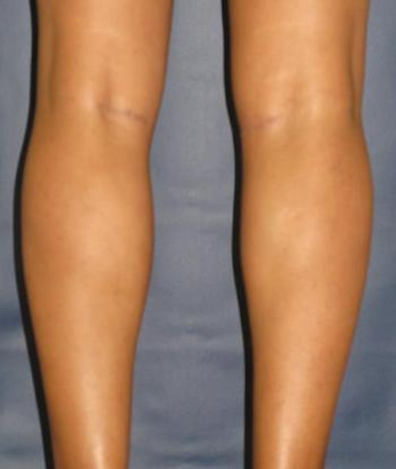Calf Augmentation with Implants Before & After Gallery - Patient 988754 - Image 4