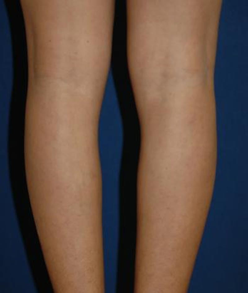 Calf Augmentation with Implants Before & After Gallery - Patient 988754 - Image 3