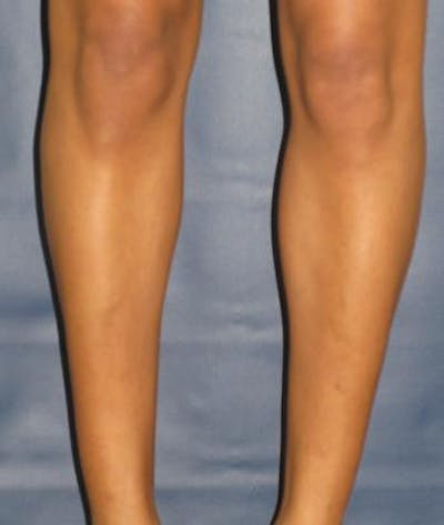 Calf Augmentation with Implants Before & After Gallery - Patient 988754 - Image 2