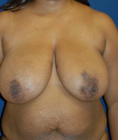 Breast Reduction Before & After Gallery - Patient 345293 - Image 1
