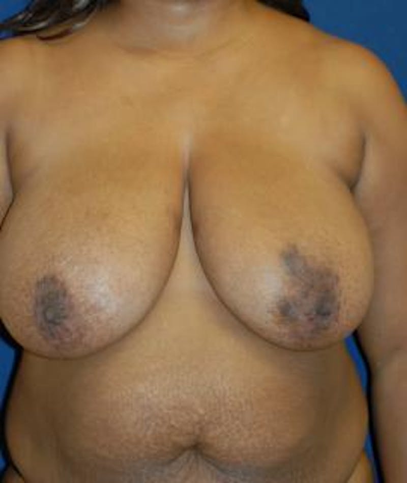 Breast Reduction Before & After Gallery - Patient 345293 - Image 1