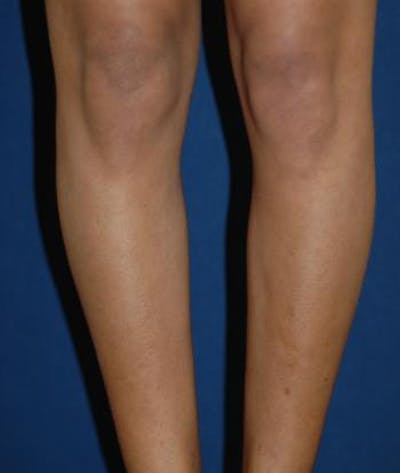 Calf Augmentation with Implants Before & After Gallery - Patient 988754 - Image 1