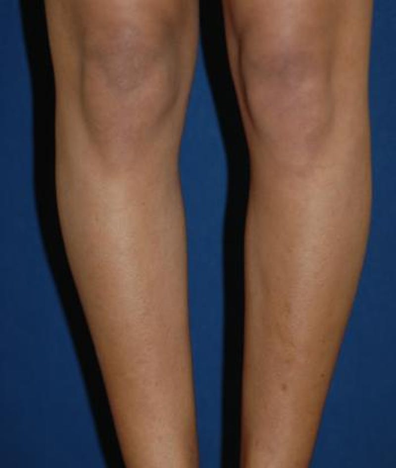 Calf Augmentation with Implants Before & After Gallery - Patient 988754 - Image 1