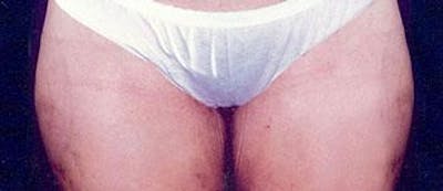 Liposuction Before & After Gallery - Patient 196740 - Image 2
