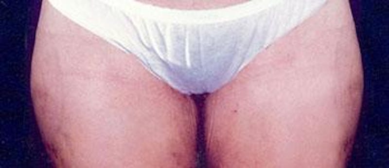 Liposuction Before & After Gallery - Patient 196740 - Image 2