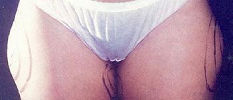Liposuction Before & After Gallery - Patient 196740 - Image 1