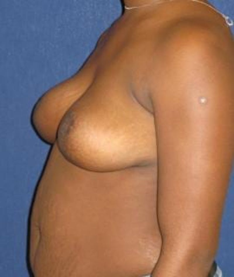 Breast Reduction Before & After Gallery - Patient 358833 - Image 4