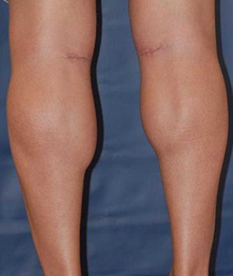 Calf Augmentation with Implants Before & After Gallery - Patient 293281 - Image 4