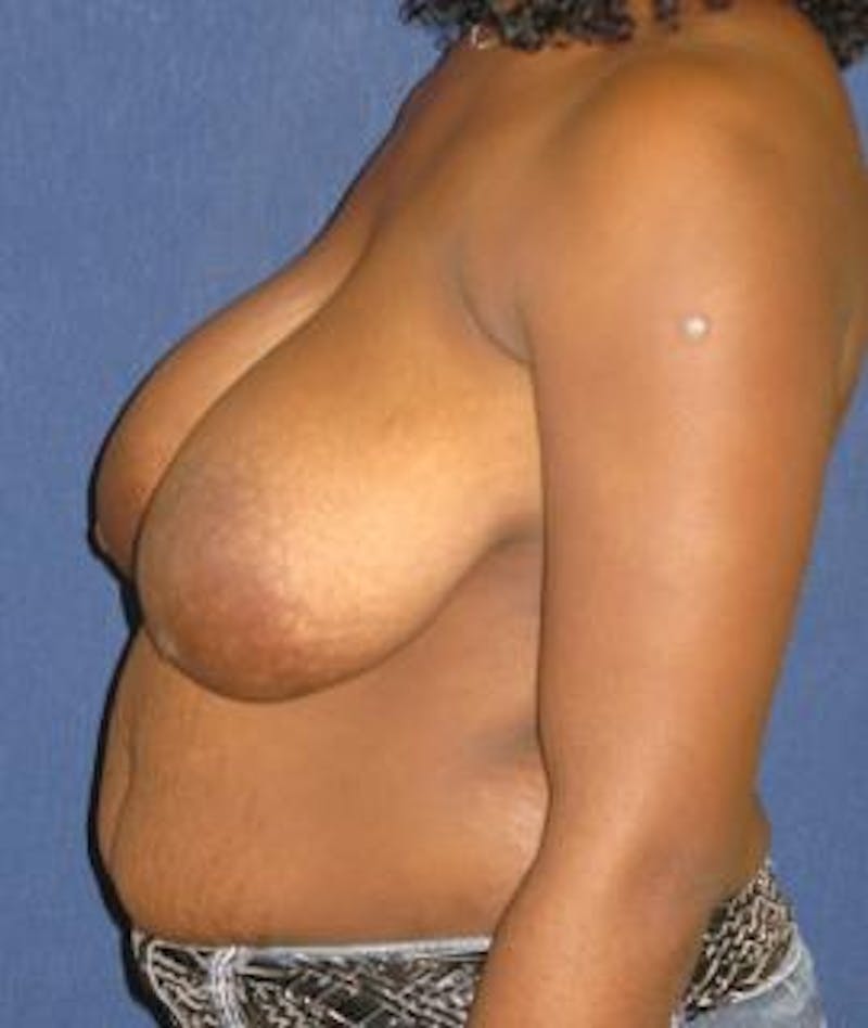 Breast Reduction Before & After Gallery - Patient 358833 - Image 3