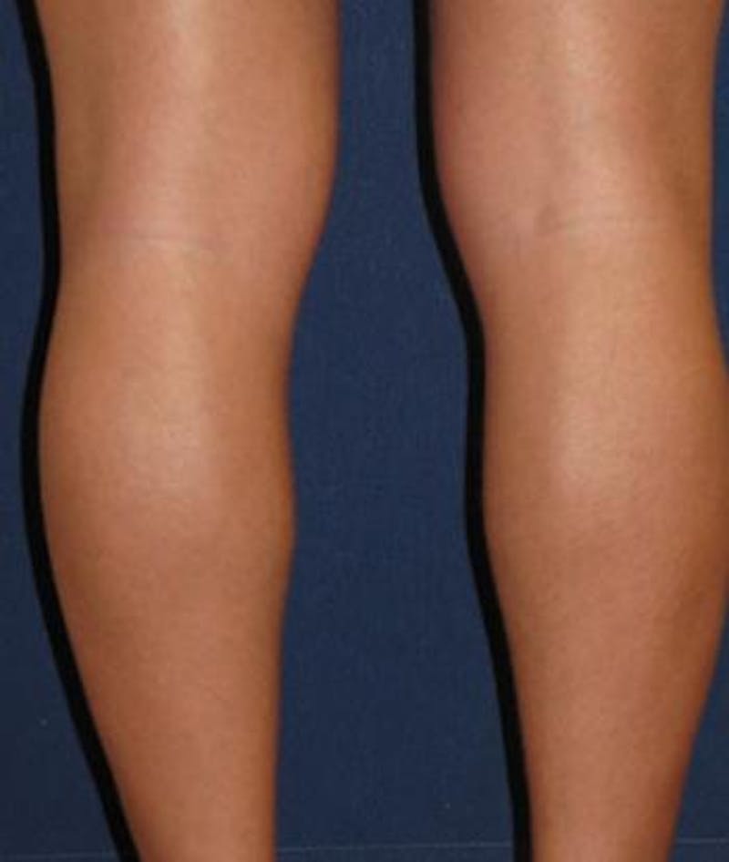Calf Augmentation with Implants Before & After Gallery - Patient 293281 - Image 3