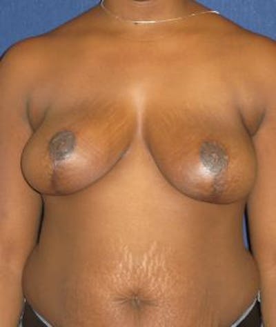 Breast Reduction Before & After Gallery - Patient 358833 - Image 2