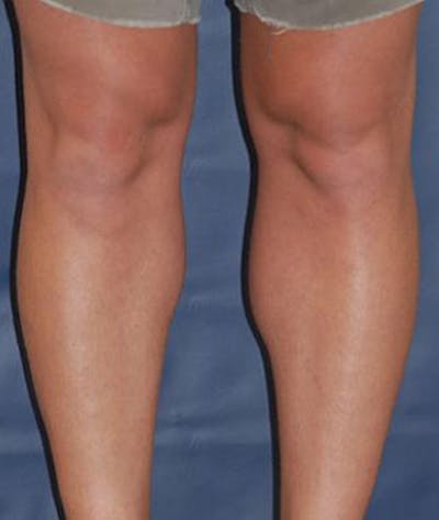 Calf Augmentation with Implants Before & After Gallery - Patient 293281 - Image 2