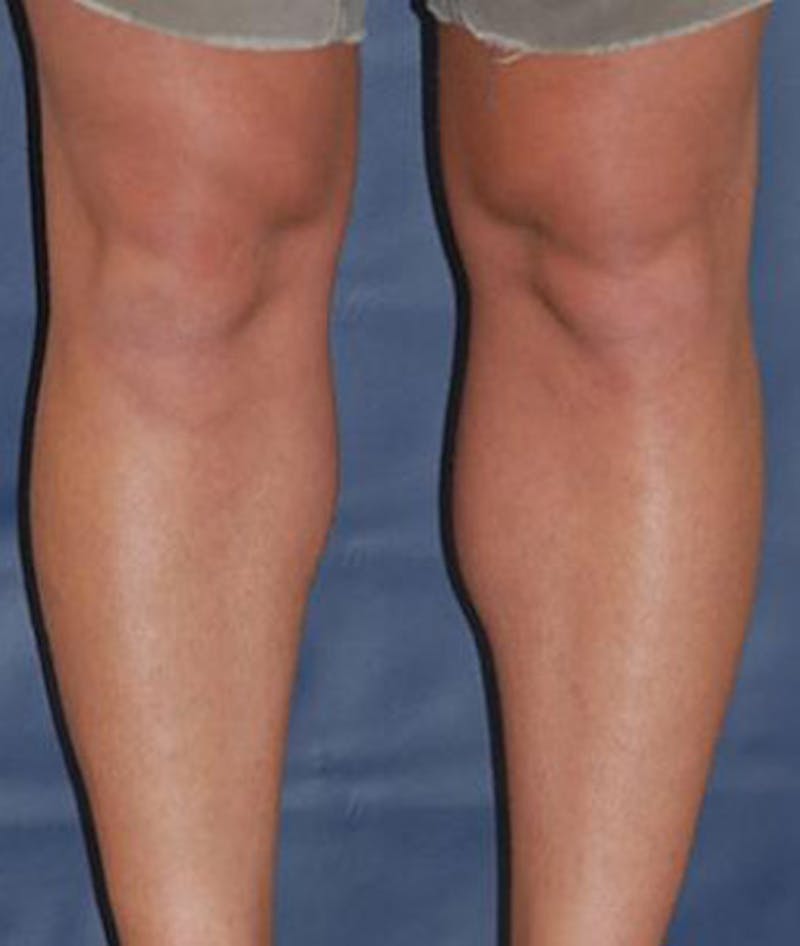 Calf Augmentation with Implants Before & After Gallery - Patient 293281 - Image 2