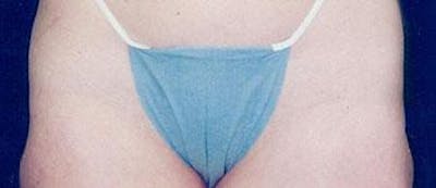 Liposuction Before & After Gallery - Patient 121502 - Image 2