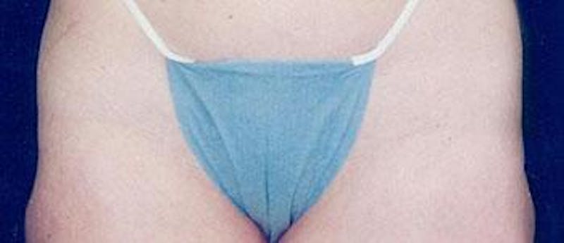 Liposuction Before & After Gallery - Patient 121502 - Image 2
