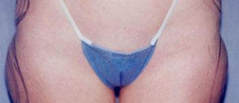 Liposuction Before & After Gallery - Patient 121502 - Image 1