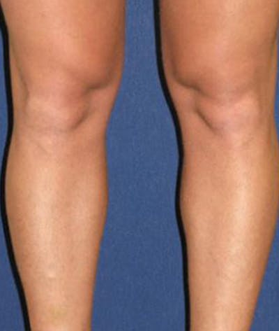 Calf Augmentation with Implants Before & After Gallery - Patient 293281 - Image 1