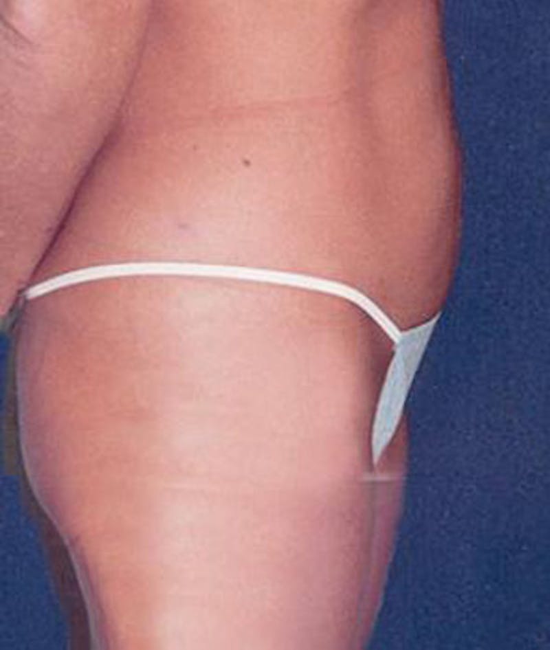 Liposuction Before & After Gallery - Patient 301588 - Image 4