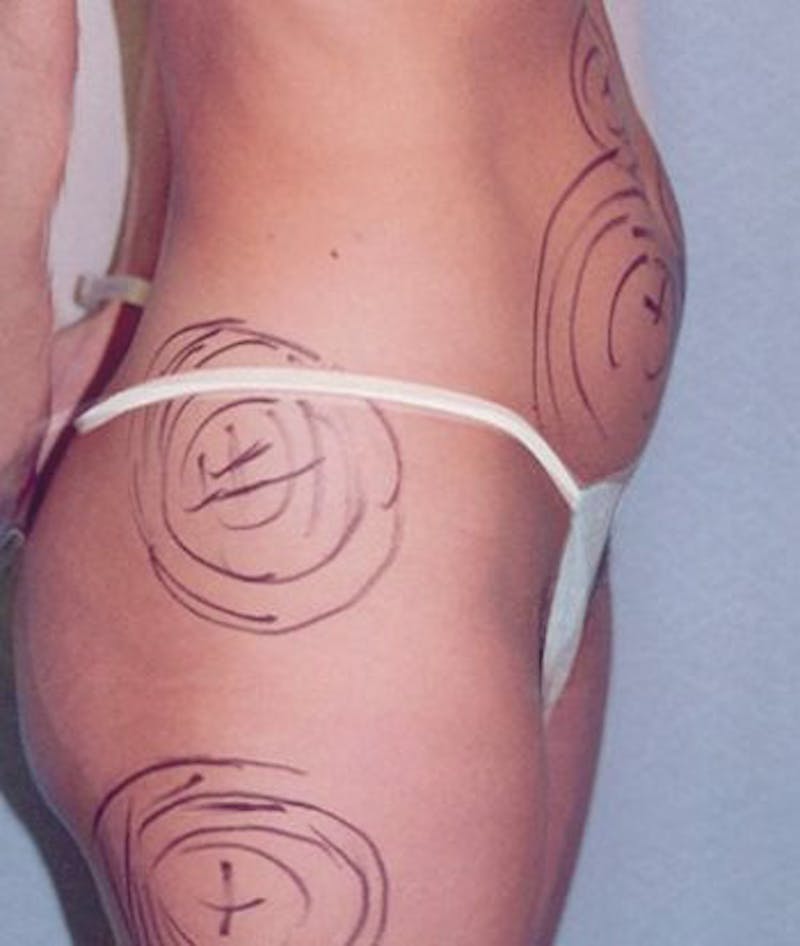 Liposuction Before & After Gallery - Patient 301588 - Image 3