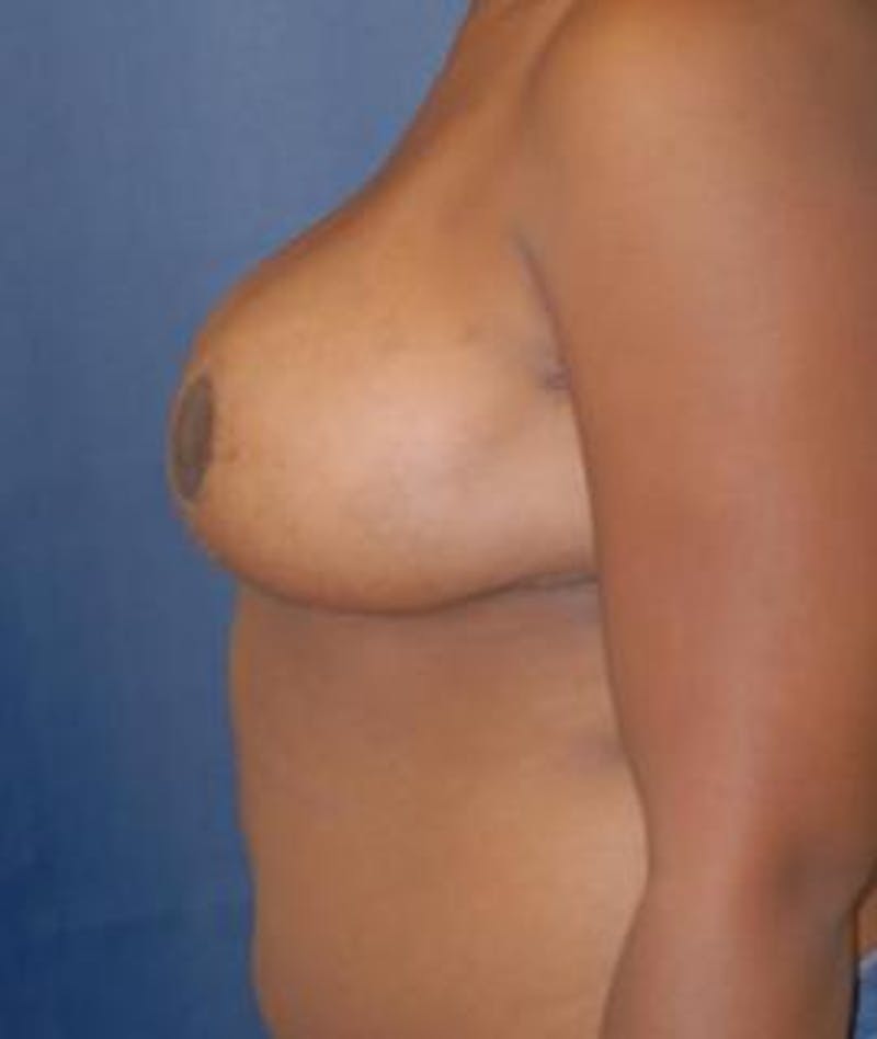 Breast Reduction Before & After Gallery - Patient 355966 - Image 6