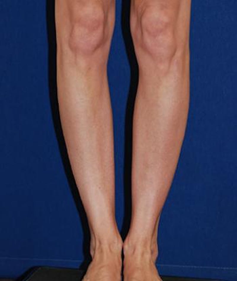 Calf Augmentation with Implants Before & After Gallery - Patient 185042 - Image 3