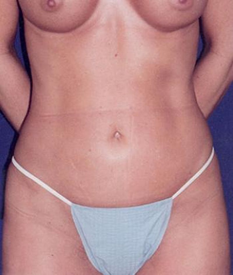 Liposuction Before & After Gallery - Patient 301588 - Image 2