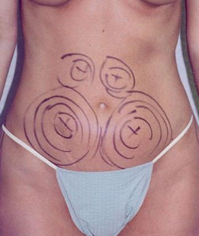 Liposuction Before & After Gallery - Patient 301588 - Image 1