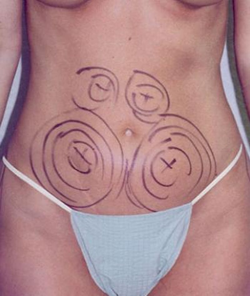 Liposuction Before & After Gallery - Patient 301588 - Image 1