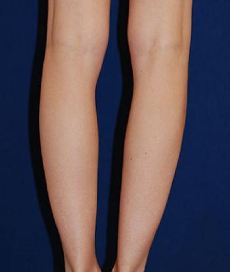 Calf Augmentation with Implants Before & After Gallery - Patient 185042 - Image 1