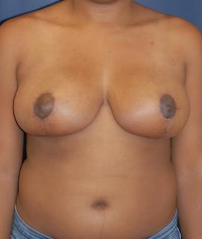 Breast Reduction Before & After Gallery - Patient 355966 - Image 2