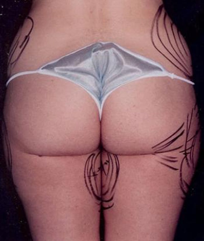 Liposuction Before & After Gallery - Patient 135172 - Image 3