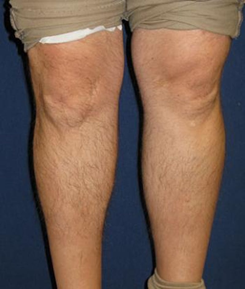 Calf Augmentation with Implants Before & After Gallery - Patient 864507 - Image 4