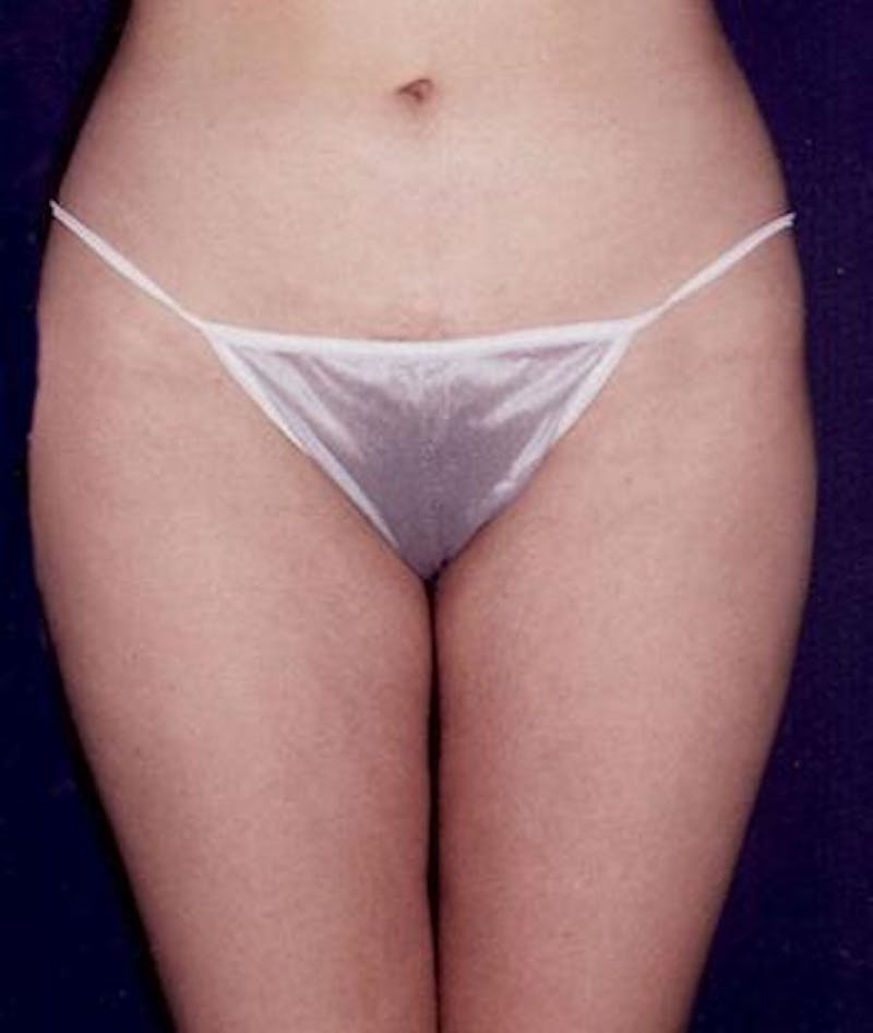 Liposuction Before & After Gallery - Patient 135172 - Image 2