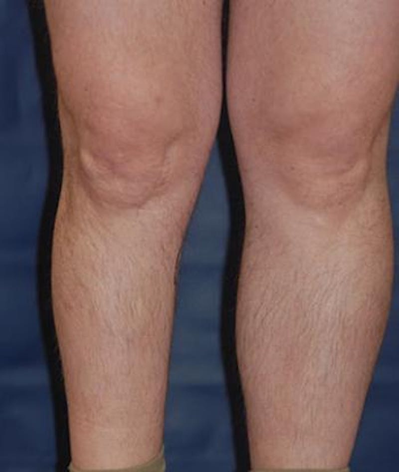 Calf Augmentation with Implants Before & After Gallery - Patient 864507 - Image 3