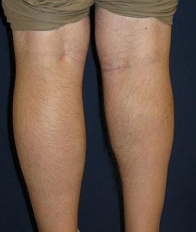 Calf Augmentation with Implants Before & After Gallery - Patient 864507 - Image 2