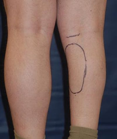Calf Augmentation with Implants Before & After Gallery - Patient 864507 - Image 1