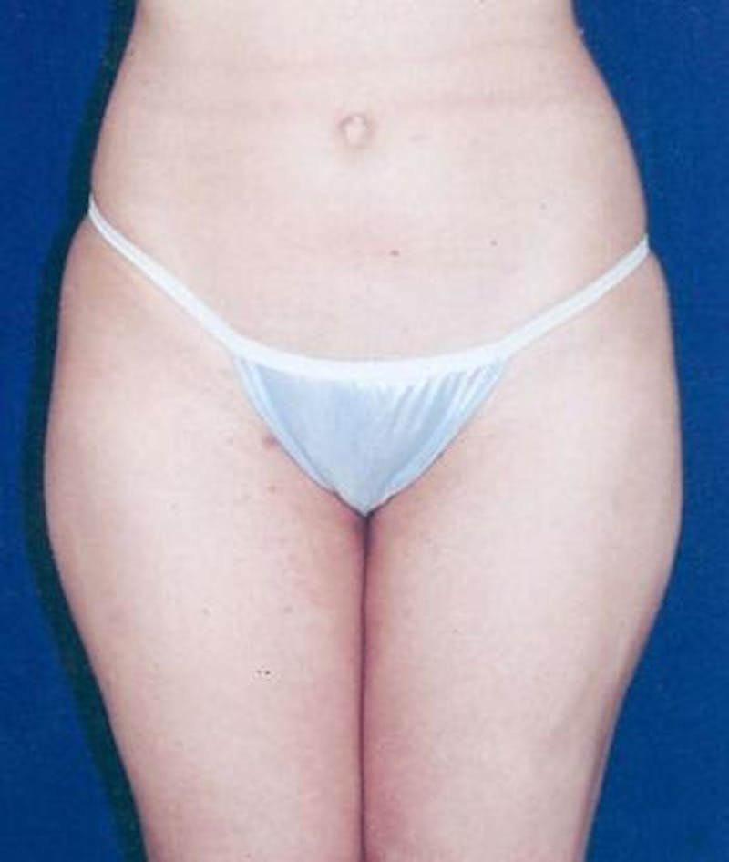 Liposuction Before & After Gallery - Patient 153221 - Image 2