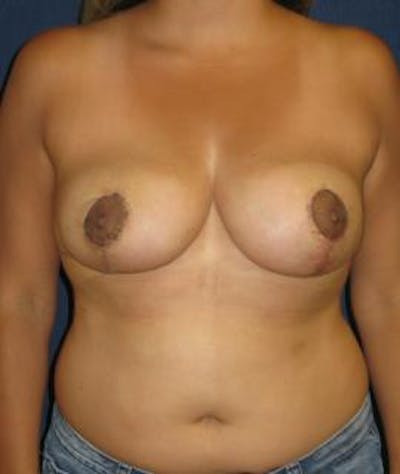 Breast Reduction Before & After Gallery - Patient 162999 - Image 2