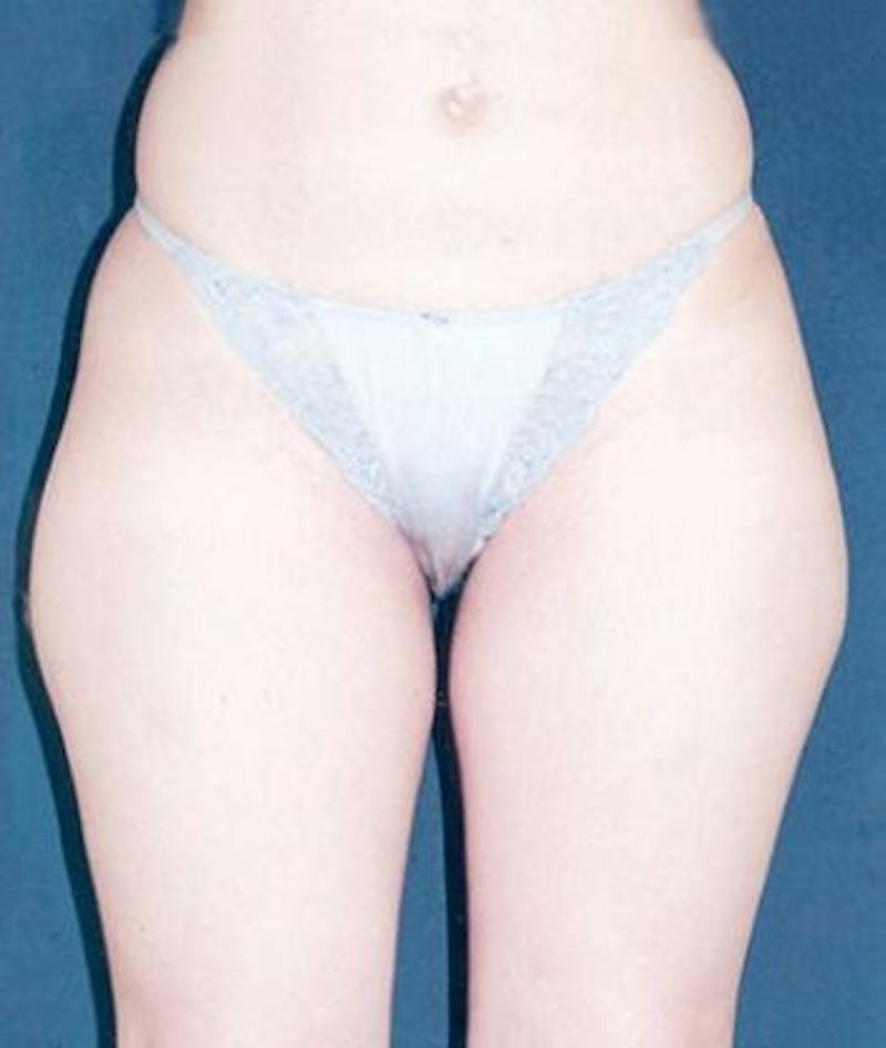 Liposuction Before & After Gallery - Patient 153221 - Image 1