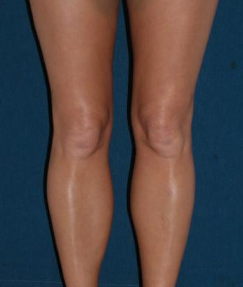 Calf Augmentation with Implants Before & After Gallery - Patient 310966 - Image 2