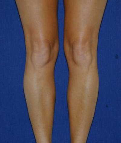 Calf Augmentation with Implants Before & After Gallery - Patient 310966 - Image 1