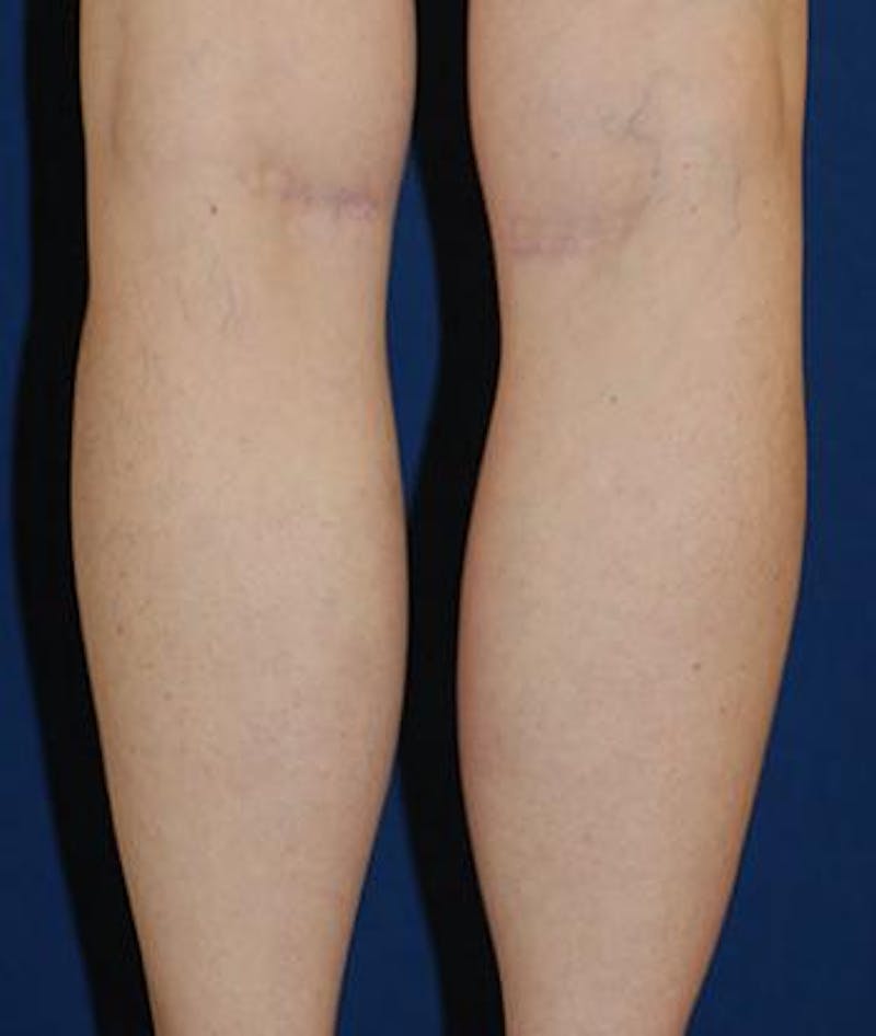 Calf Augmentation with Implants Before & After Gallery - Patient 147016 - Image 4