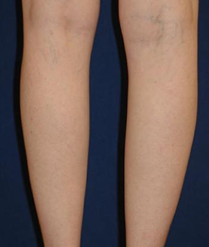 Calf Augmentation with Implants Before & After Gallery - Patient 147016 - Image 3