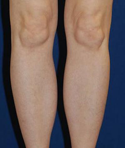 Calf Augmentation with Implants Before & After Gallery - Patient 147016 - Image 2