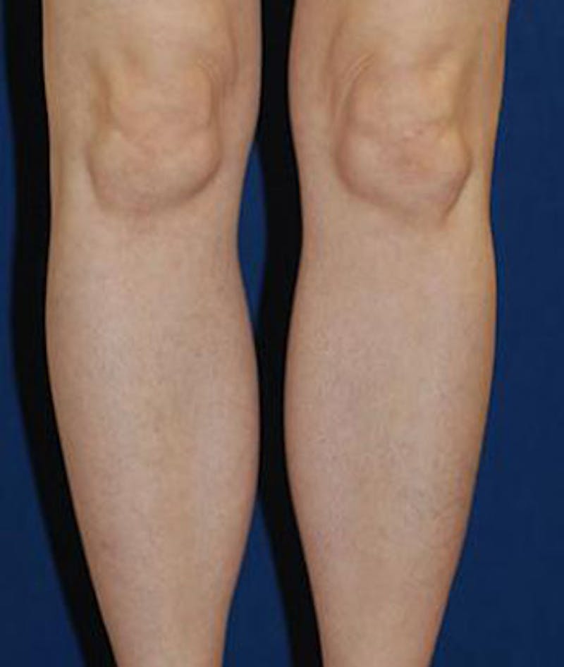 Calf Augmentation with Implants Before & After Gallery - Patient 147016 - Image 2