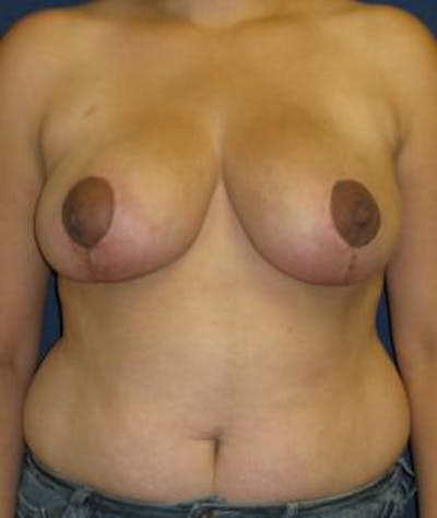 Breast Reduction Before & After Gallery - Patient 140571 - Image 2