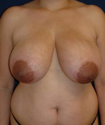 Breast Reduction Before & After Gallery - Patient 140571 - Image 1