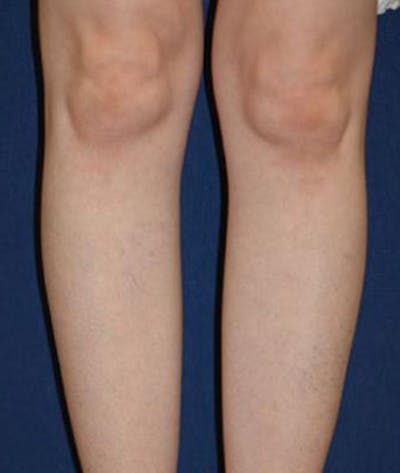 Calf Augmentation with Implants Before & After Gallery - Patient 147016 - Image 1