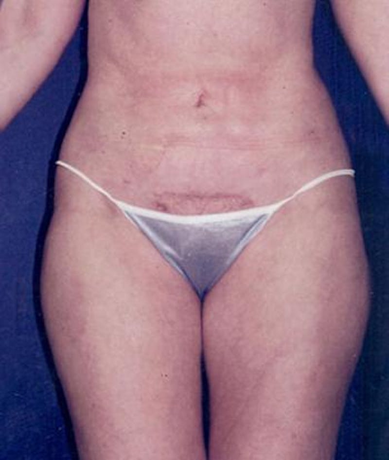 Liposuction Before & After Gallery - Patient 108872 - Image 2